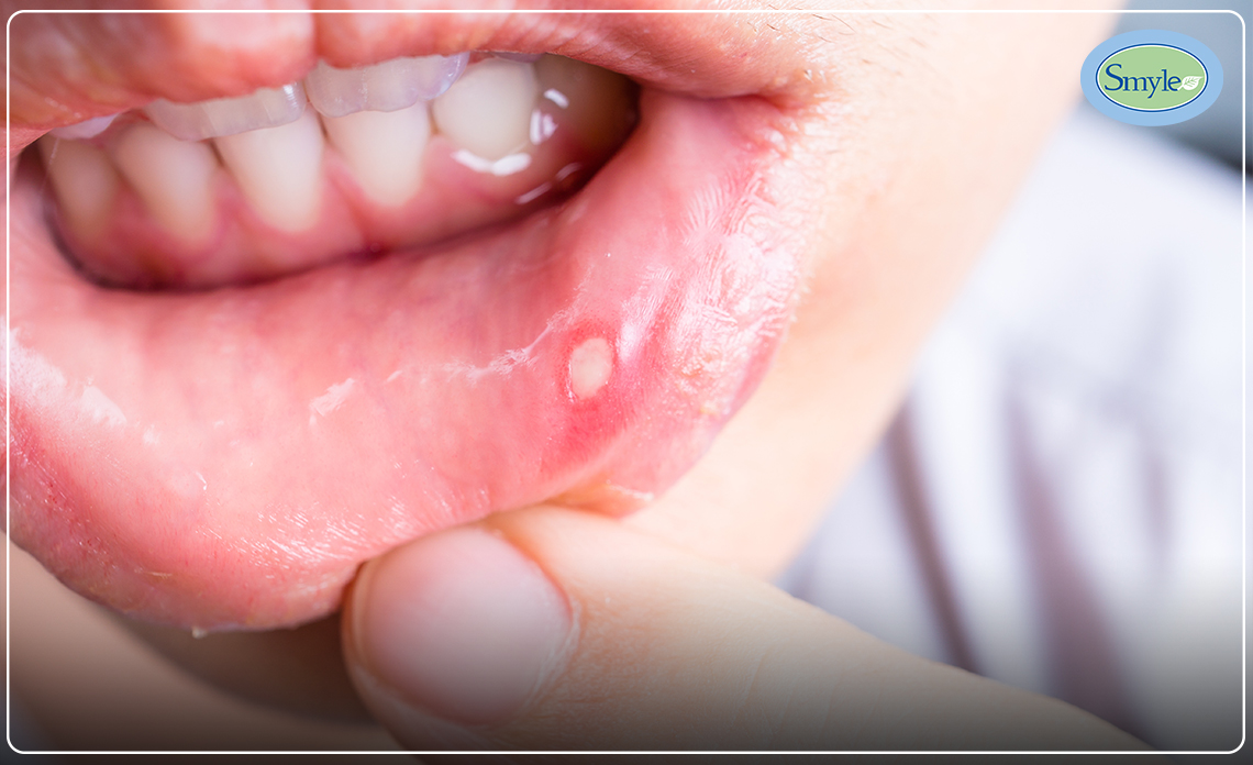 Top 10 Remedies For Mouth Ulcer
