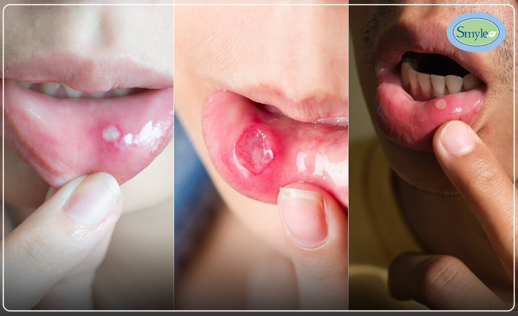 Different Types of Mouth Ulcer