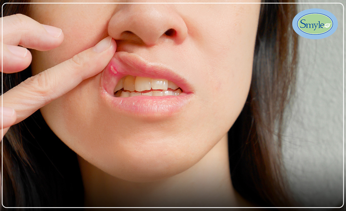 What are the Common Reasons Behind Mouth Ulcer