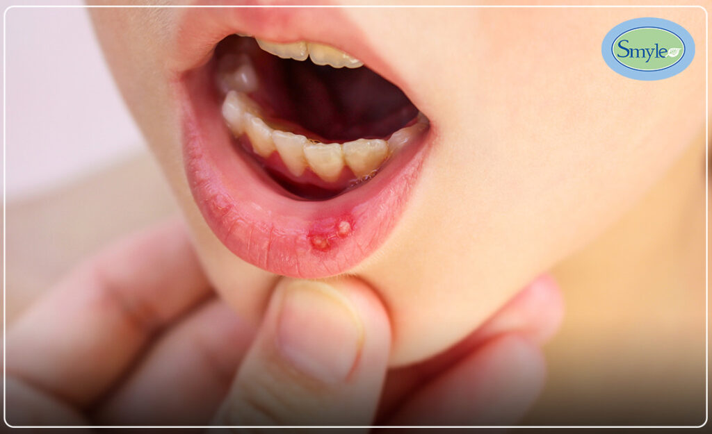 What are the Common Symptoms To Identify Mouth Ulcer