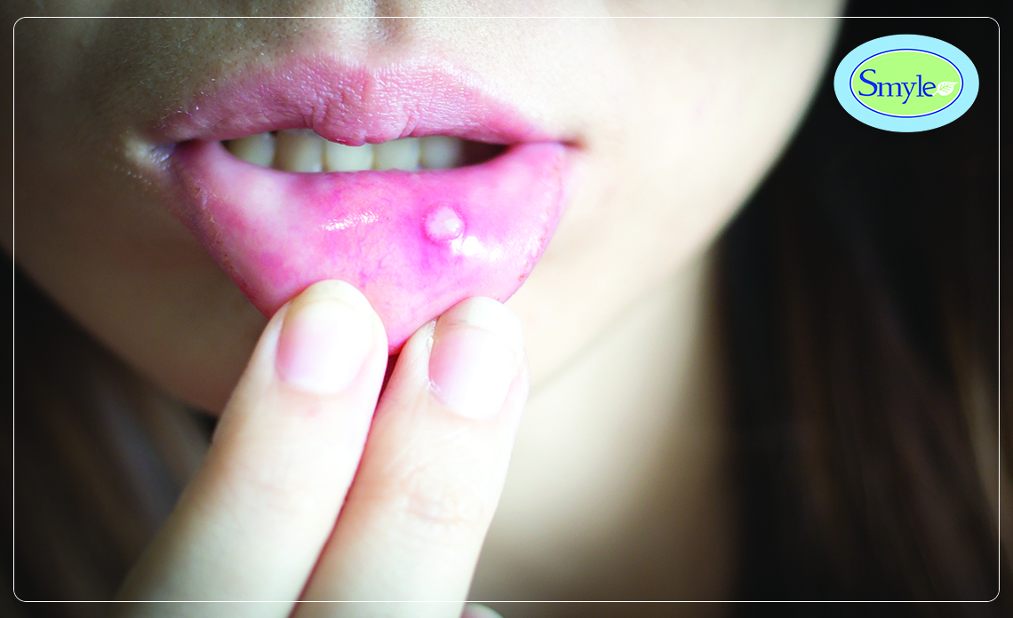 What are Mouth Ulcers? What Causes Mouth Ulcers and How Can I Prevent Them?